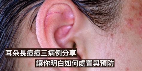 耳朵長痘痘面相|【耳朵長痘痘面相】「發大財」徵兆！謹慎留意「耳朵長痘痘面相。